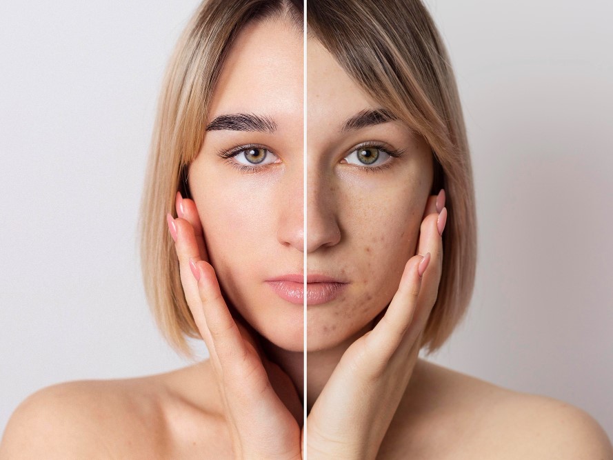 Pigmentation Treatment in Mumbai