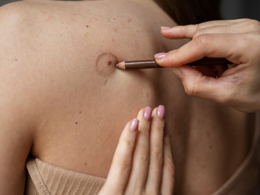 Scar Reduction Treatment Mumbai