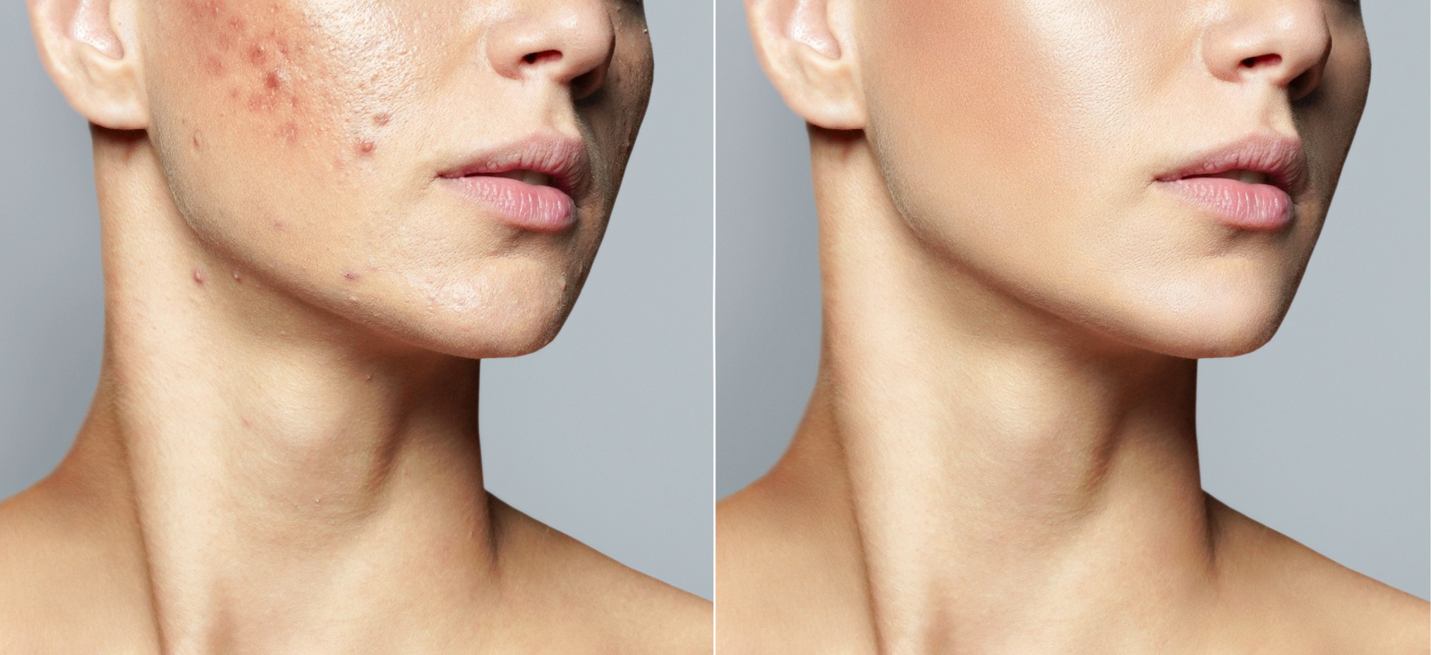 Acne Scar Treatment in Mumbai