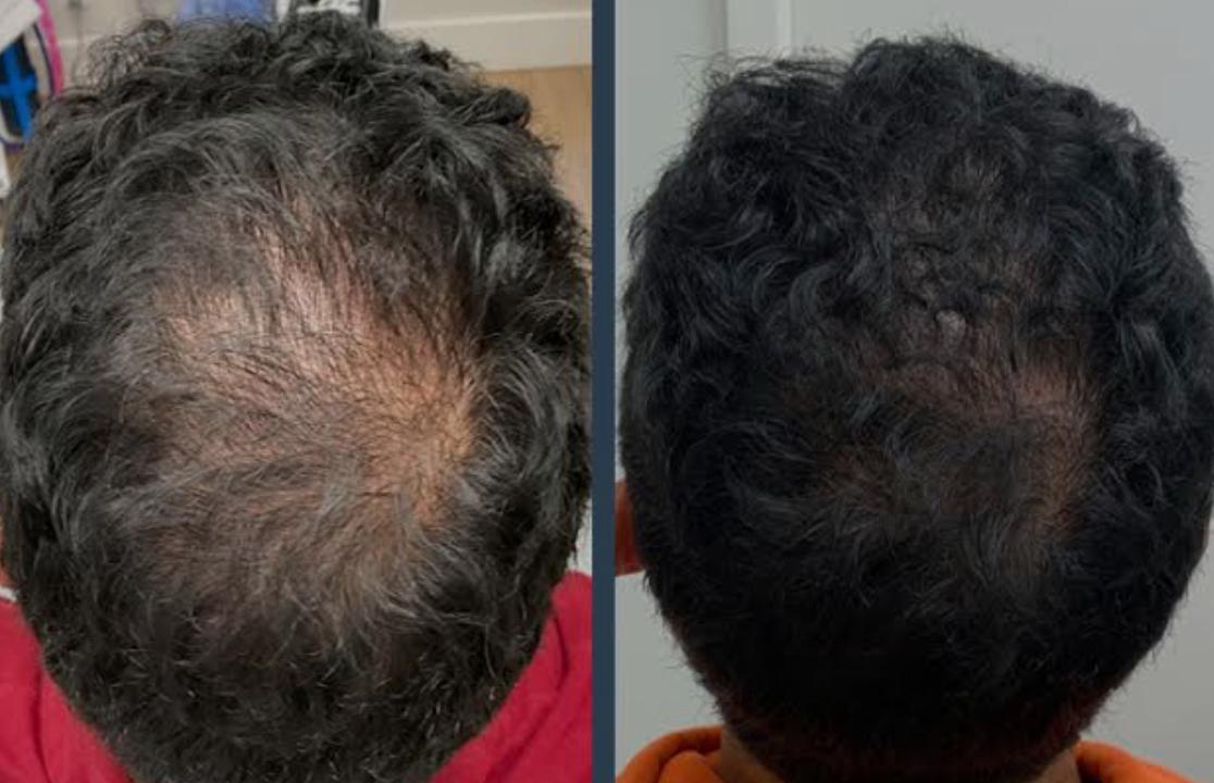 Exosomes Treatment in Mumbai