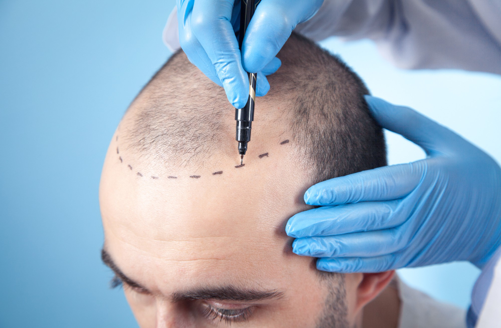 Hair Transplant in Mumbai