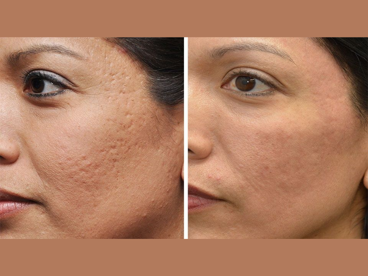 Permanent acne scar removal