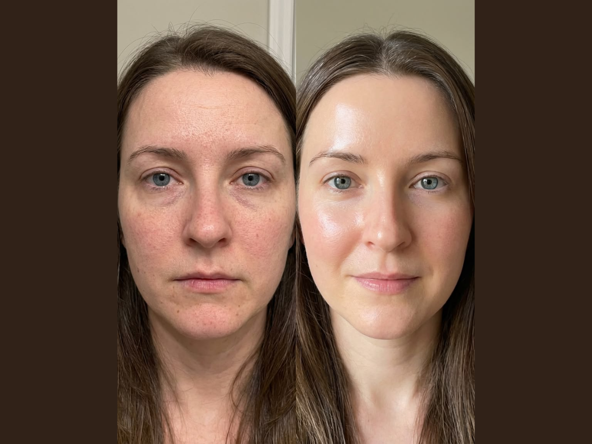 Post inflammatory hyperpigmentation